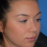 Rhinoplasty Before & After Patient #1602
