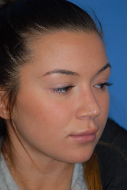 Rhinoplasty Before & After Patient #1602