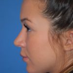 Rhinoplasty Before & After Patient #1602