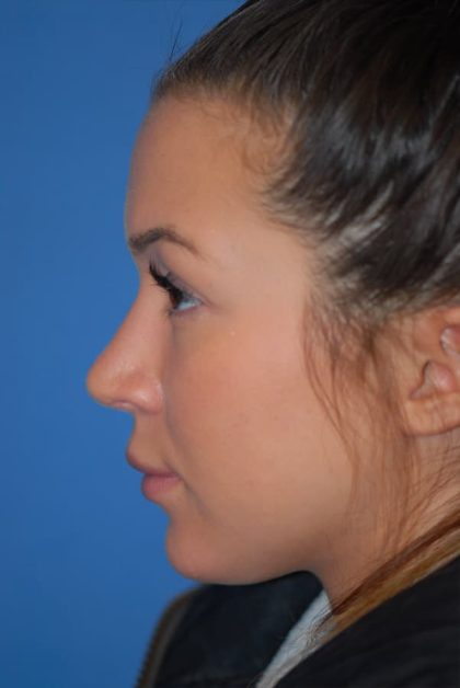 Rhinoplasty Before & After Patient #1602