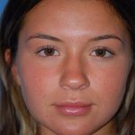 Rhinoplasty Before & After Patient #1602