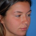 Rhinoplasty Before & After Patient #1602