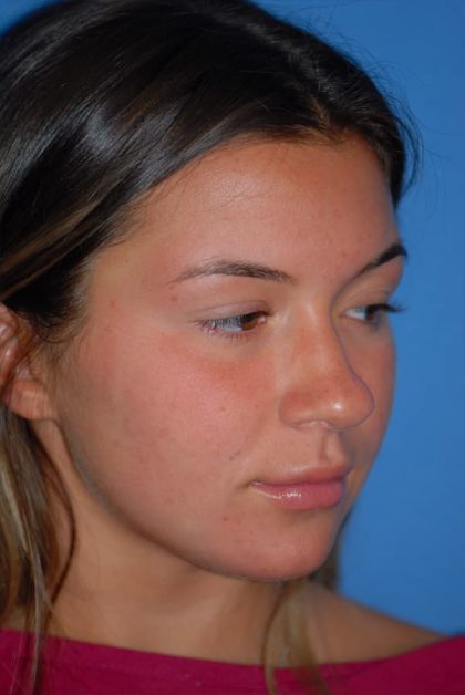 Rhinoplasty Before & After Patient #1602