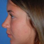 Rhinoplasty Before & After Patient #1602