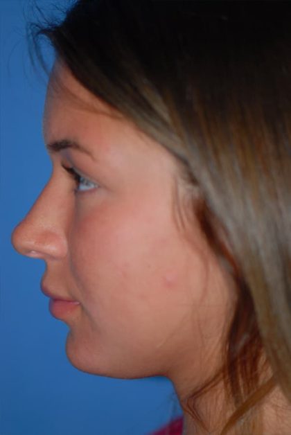 Rhinoplasty Before & After Patient #1602