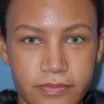 Rhinoplasty Before & After Patient #1601
