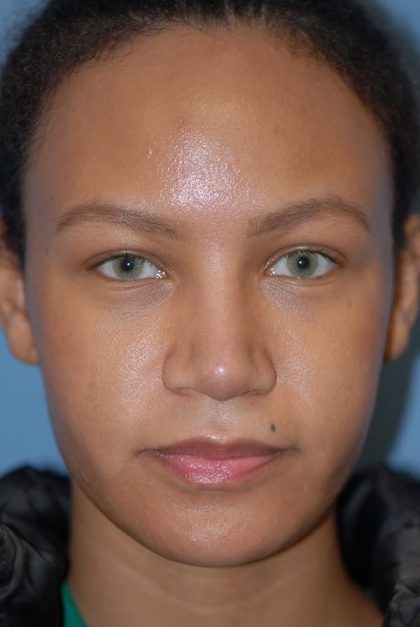 Rhinoplasty Before & After Patient #1601