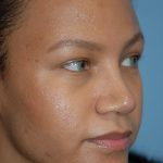 Rhinoplasty Before & After Patient #1601