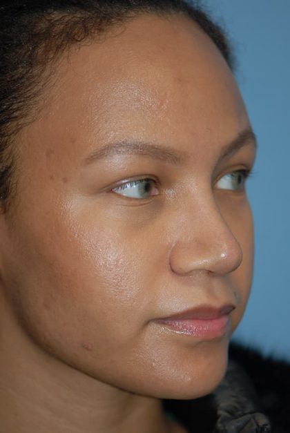 Rhinoplasty Before & After Patient #1601