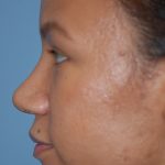 Rhinoplasty Before & After Patient #1601