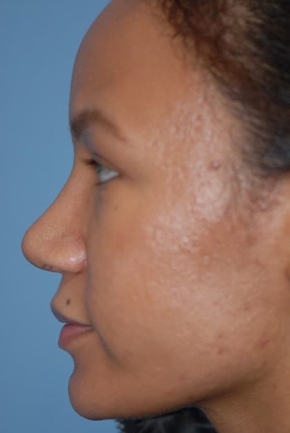 Rhinoplasty Before & After Patient #1601