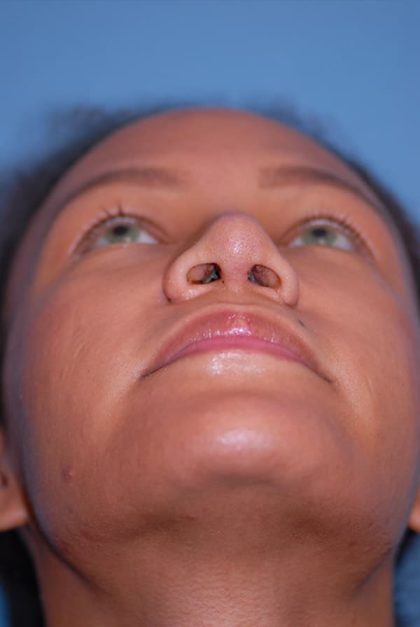 Rhinoplasty Before & After Patient #1601