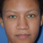 Rhinoplasty Before & After Patient #1601