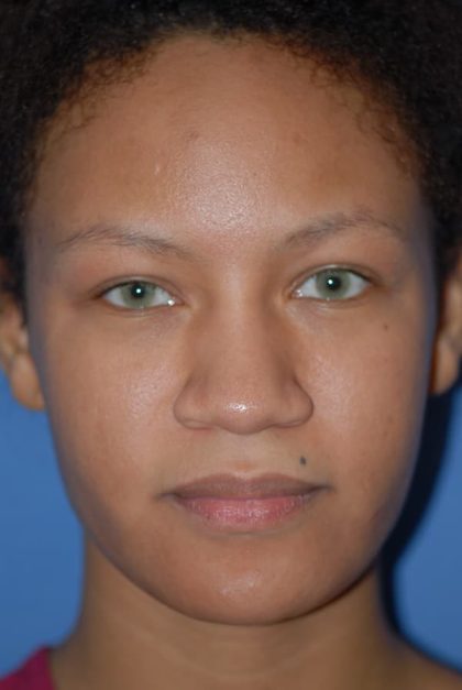 Rhinoplasty Before & After Patient #1601