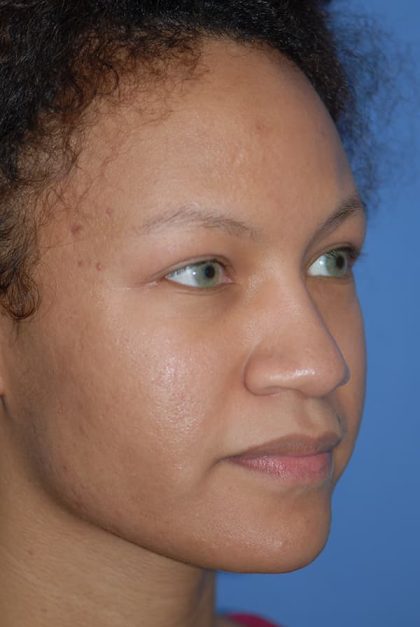 Rhinoplasty Before & After Patient #1601