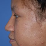 Rhinoplasty Before & After Patient #1601