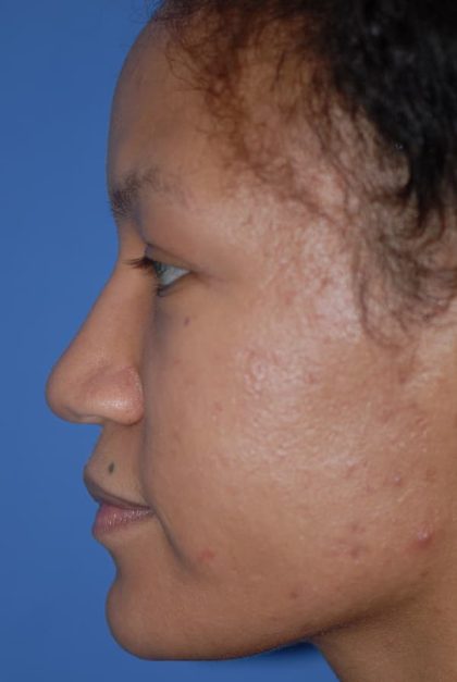 Rhinoplasty Before & After Patient #1601