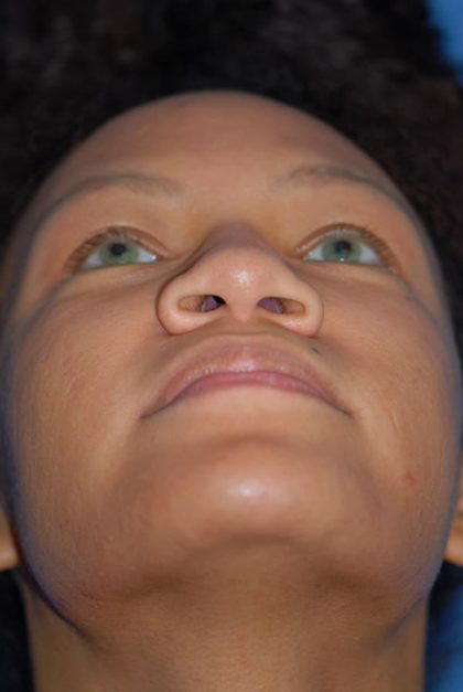 Rhinoplasty Before & After Patient #1601