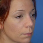 Rhinoplasty Before & After Patient #1600