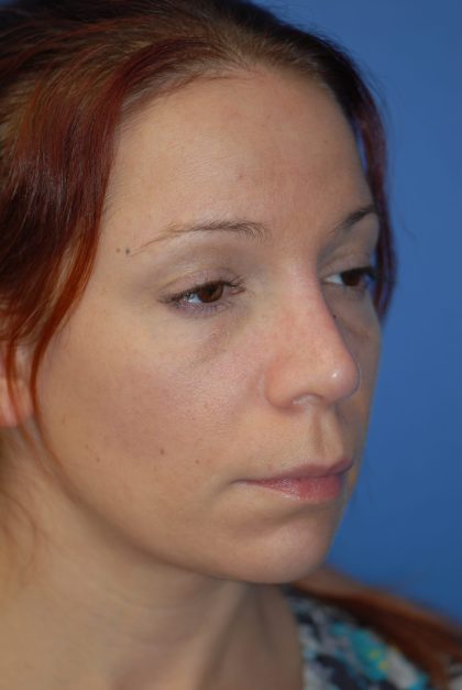 Rhinoplasty Before & After Patient #1600