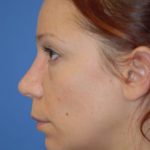 Rhinoplasty Before & After Patient #1600