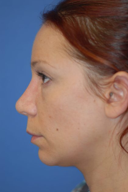 Rhinoplasty Before & After Patient #1600