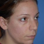 Rhinoplasty Before & After Patient #1600