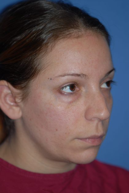 Rhinoplasty Before & After Patient #1600