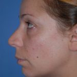 Rhinoplasty Before & After Patient #1600