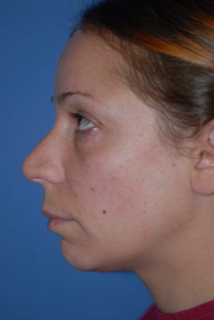 Rhinoplasty Before & After Patient #1600