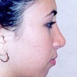 Rhinoplasty Before & After Patient #1599