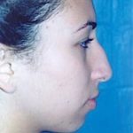 Rhinoplasty Before & After Patient #1599