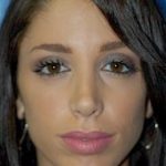 Rhinoplasty Before & After Patient #1598