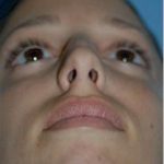 Rhinoplasty Before & After Patient #1598