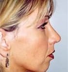 Rhinoplasty Before & After Patient #1597