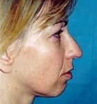 Rhinoplasty Before & After Patient #1597