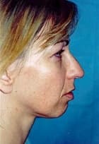 Rhinoplasty Before & After Patient #1597