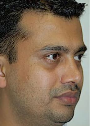 Rhinoplasty Before & After Patient #1595