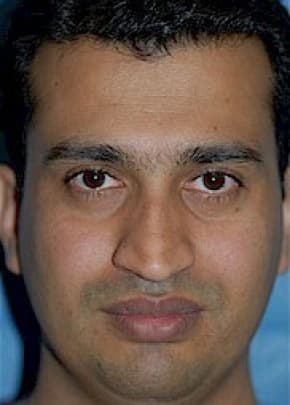 Rhinoplasty Before & After Patient #1595
