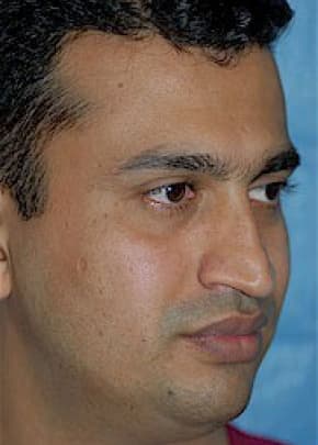Rhinoplasty Before & After Patient #1595