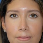 Rhinoplasty Before & After Patient #1594