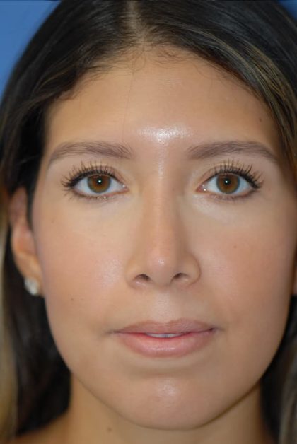 Rhinoplasty Before & After Patient #1594