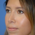 Rhinoplasty Before & After Patient #1594