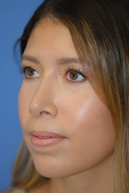 Rhinoplasty Before & After Patient #1594