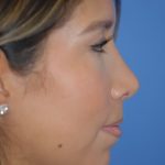 Rhinoplasty Before & After Patient #1594