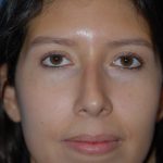 Rhinoplasty Before & After Patient #1594