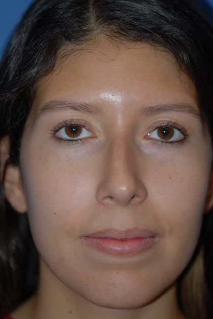 Rhinoplasty Before & After Patient #1594