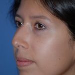 Rhinoplasty Before & After Patient #1594