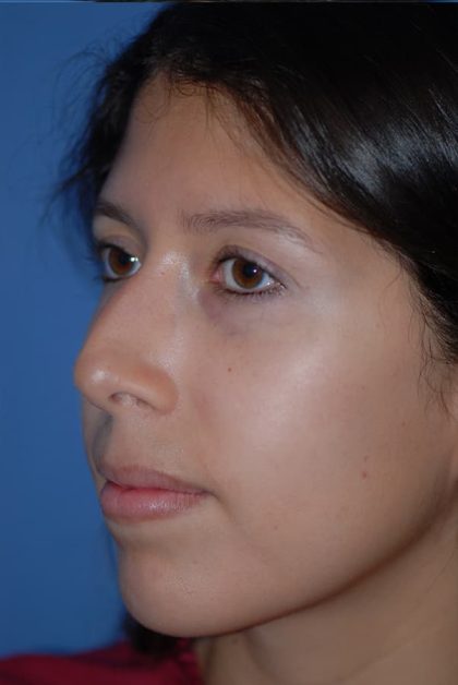 Rhinoplasty Before & After Patient #1594