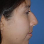 Rhinoplasty Before & After Patient #1594